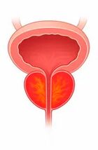 Zapalenie gruczołu krokowego